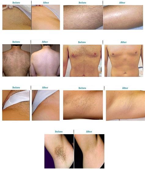 It can be done on other parts of the body too, like the armpits. Before and After Results of Laser Hair Removal using the ...