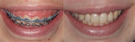 proIsrael: Why Do My Gums Itch With Braces