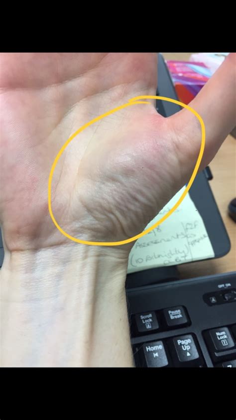 It was a work related injury and he received workers comp for it (including doctors visits and physical in december/january john was spending too much time typing and got (diagnosed) carpal tunnel. Carpal tunnel vs tenosynovitis! | Tendon Problems | Forums ...