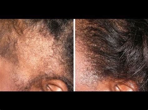 17 best oils for natural hair growth HOW TO GROW YOUR EDGES BACK IN 2 WEEKS - YouTube | Black ...