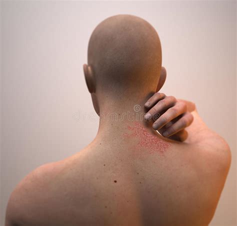 Uomo Con Il Problema Della Dermatite Dell'eruzione ...