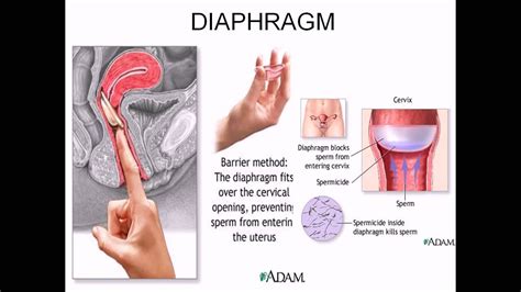 Maybe you would like to learn more about one of these? Diaphragm contraceptive - YouTube