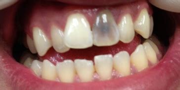 Chipped, broken, and dislodged teeth are common and each scenario can be very painful. Combination of Services