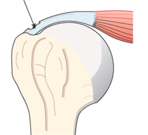 5 comment une rupture du tendon d'achille est diagnostiquée? Les lésions de la coiffe des rotateurs - INSTITUT DE L ...