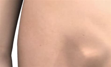Jump to navigation jump to search. Hernia in women - Symptoms, Causes, Treatment, Pictures