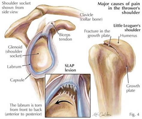 Shoulder labral tears | beacon orthopaedics & sports medicine. labrum glenoidale - Google zoeken | Shoulder surgery ...