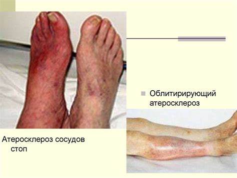 Атеросклероз диета при СП при атеросклерозе - online presentation СП при атеросклерозе - online presentation Атеросклероз диета при