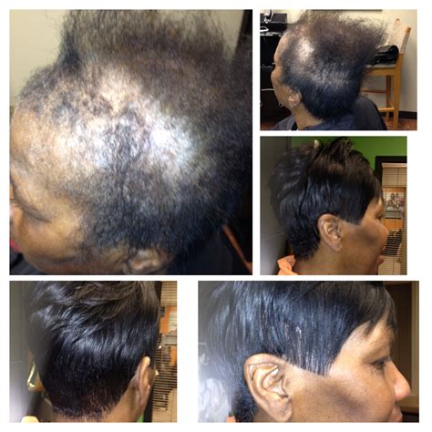 Once transplanted, the hair grows normally. Full Custom Sewin 'No Glue' Natural looking Sewin Thinning ...