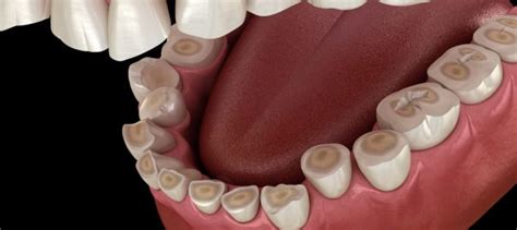 Your dentist can custom fit you for a night guard, which is an appliance that fits over your btw we all grind our teeth at times as do other primates as well as other animals. How to Stop Grinding My Teeth! | Samaritan Dental Arts