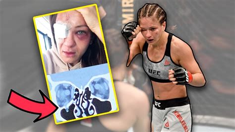 'i definitely think that i've gotten better since my last fight and that i'm still here. Doctor Explains Serious UFC Eye Injury for Karolina ...