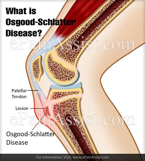 Accueil » remèdes naturels » dites adieu à la goutte avec ce puissant traitement naturel. What is Osgood-Schlatter Disease? | Osgood schlatter ...