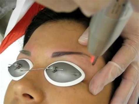 Laser removal has been used for so long to remove unwanted tattoos. Laser Tattoo Removal - Permanent Makeup Eyebrow # ...