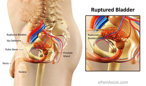 Urinary Bladder Rupture: Causes, Types, Symptoms ...