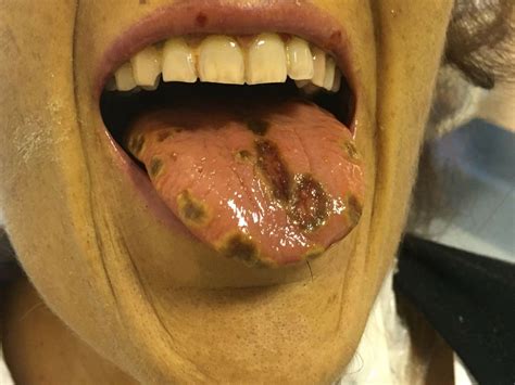 The herpes simplex virus is incredibly common in the united states and worldwide. Unusual oral presentation of HSV-1 lesions in an adult ...