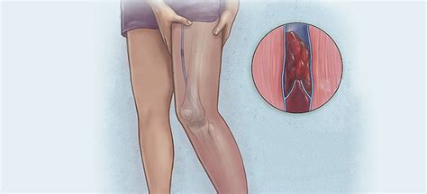 Trombóza je tvorba krvných zrazenín na stenách ciev. Tromboza venoasă profundă | Sacré-Cœur Vascular