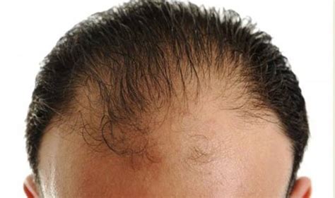 This is followed by increasing diffuse hair loss radiating. Receding Hairline: Signs & Treatment - HairstyleCamp