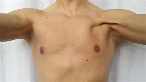 Check spelling or type a new query. Gyno does not make your pec deformed. An injury does ...