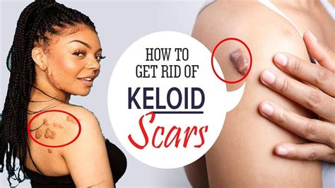 Read on for our list of top home remedies to get smooth, beautiful skin. How to Get Rid of Keloid Scars || Home Remedies for Keloid ...