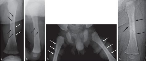 Lower extremity trauma | Radiology Key