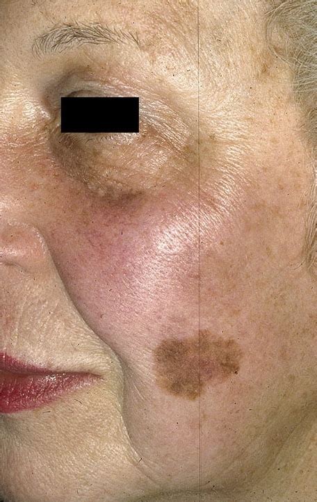 Asymmetry, border that's irregular, color that's uneven, diameter bigger than a. Skin Cancer on Face Pictures - 33 Photos & Images ...