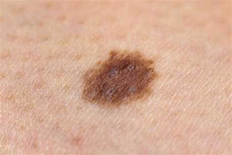 What does the start of age spots look like? Melanoma 101: Causes, Risk Factors, Types, and Stages