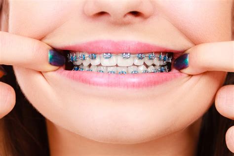 Can you still get braces treatment if you have teeth missing? Braces For Your Teeth: Why They're So Important In Some ...