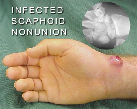 The proximal row carpectomy has been performed removing the scaphoid, lunate and triquetrum leaving a space for the graft to be inserted. Figure 1400001S
