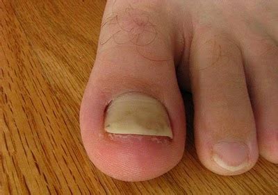 Symptoms of yellow fungus are lethargy, poor or no appetite at all, and weight loss. Juwita Blog: Health Tips Facts - Yellow Toenails Symptoms ...