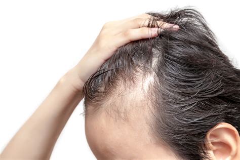 Hypothyroidism Baldness - HealthlyDailys