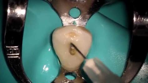 Access opening this video is about access opening in mandibular first molar. Mandibular Canine - YouTube