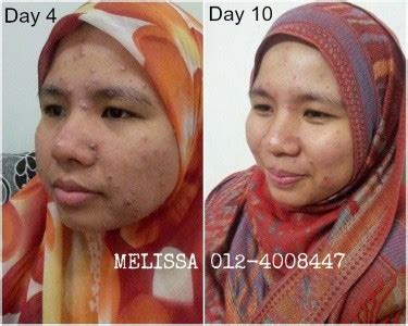 Demam adalah suatu keadaan saat suhu badan melebihi 37oc yang disebabkan oleh penyakit atau peradangan 응답하라 1988 10화 다운로드. Ubat Demam Panas Untuk Orang Dewasa - Harga HP 4