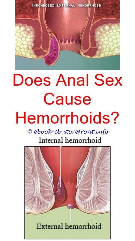 In this video you can see what internal hemorrhoids look like inside you! 4 Astonishing Diy Ideas: Does Walking Aggravate Hemorrhoids how to reduce external hemorrhoid ...