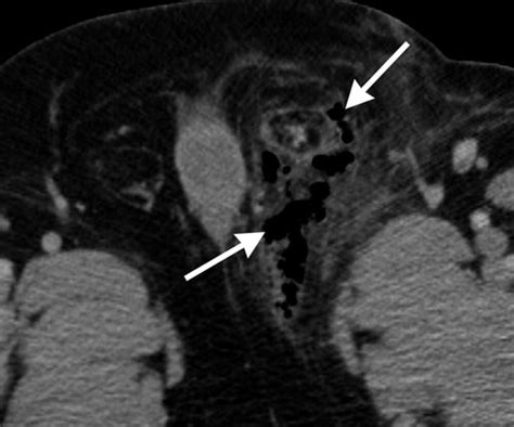 Nepuk gorenoise project see more of fournier gangrene on facebook. Fournier Gangrene: Role of Imaging | RadioGraphics