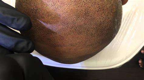 Scalp Micropigmentation SMP Treatment Process - First Pass ...