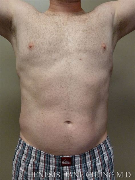 Kpix 5 tv schedule watch: San Jose Gynecomastia Before and After Photos - San ...