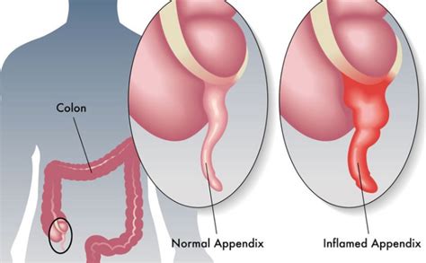 Inflammation et infection du péritoine, membrane qui continue qui tapisse la cavité abdominale et ses viscères, grave, qui non traitée, est mortelle. Appendicite | Dottor Antonio Giuliani