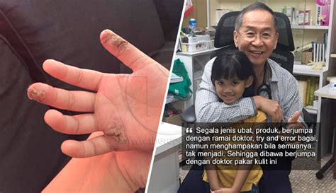 Pergi ke klinik pakar kulit, doktor beri ubat cream dan cecair mandian, kos rawatan sekali pergi lebih kurang rm110.00 hingga rm150.00, namun penyakit alahan kulit, ruam, eczema anak saya masih tidak berubah. 'Malam-malam dia menangis sakit luka pedih disebabkan ...