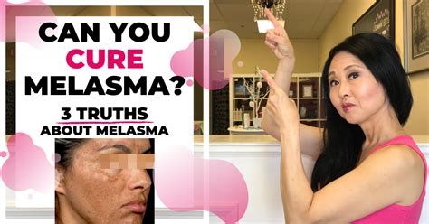 No one knew how to naturally treat breast lumps? 3 Truths of Melasma -Hyperpigmentation causes and Treatments