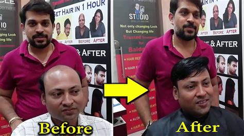 A new hair weave is a great way to mix up your style, and give your look a new bit of flair. Hair Replacement system for men in Surat | Hair loss ...