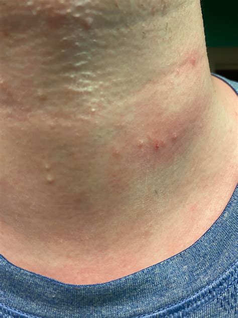 [Skin Concerns] itchy skin colored pimple looking things on neck that ...