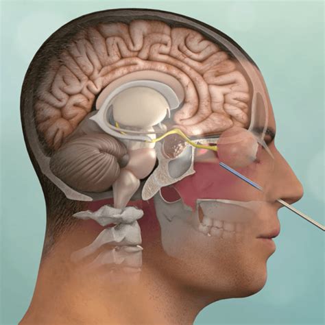 Endoscopic Surgery for Chordoma Treatment | Pacific ...