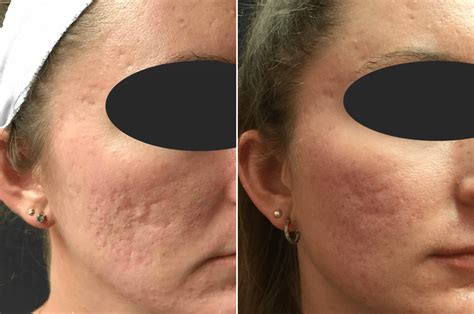 Jun 21, 2021 · microneedling is a favorite among beauty editors because of its quick and noticeable results for scarring and general uneven texture. Shedding Microneedling : / Preparing for microneedling at ...