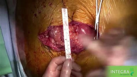 Organ herniation through a ring of tissue confined within the abdominal cavity, such as a diaphragmatic hernia or organ displacement through a mesenteric rent. Surgimend Abdominal Hernia Repair Reinforcement Video - Dr ...