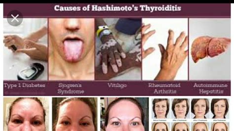 Thyroiditis includes a group of individual disorders causing thyroidal inflammation but presenting in different ways. Hypothyroidism-2/hashimoto's thyroiditis - YouTube