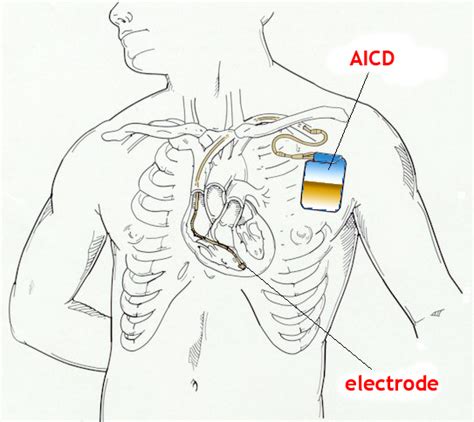 La fibrillazione ventricolare è un'aritmia che si caratterizza per un ritmo cardiaco caotico e disorganizzato che origina dai ventricoli. Tachicardia Ventricolare