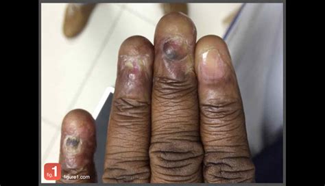 Naegelifranceschettijadassohn syndrome nfjs also known as chromatophore nevus of naegeli and naegeli syndrome is a rare autosomal dominant form of ectod. Image of the Week: A rare dermatologic finding - Clinical ...