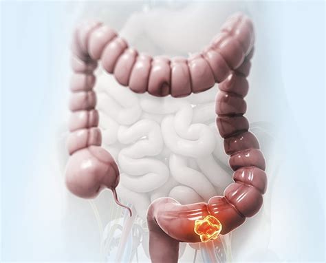 Das protein calprotectin stellt so einen biomarker dar. Patienten