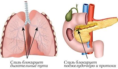 Учебное пособие для врачей / а. Муковисцидоз. Симптомы у взрослых, детей, диагностика ...