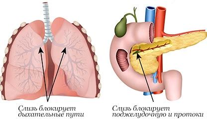 Являются интубация, лечение антибиотиками, пребывание в палатах интенсивной терапии. Муковисцидоз. Симптомы у взрослых, детей, диагностика ...