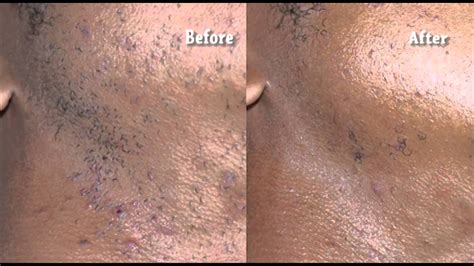 Brod, m.d., clinical professor of dermatology in. Getting Rid Of Ingrown Hairs | Uphairstyle